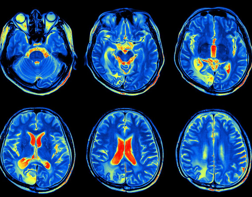 Новые тенденции в медицинской диагностике: Как контрастное МРТ головного мозга изменяет подход к обследованию пациентов